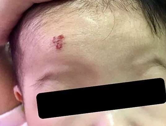 嬰兒頭上的血管瘤。大里仁愛醫院提供