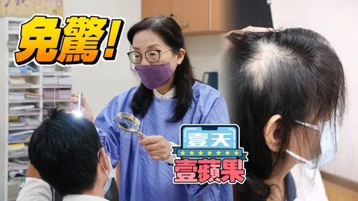 打新冠疫苗或確診後竟患圓形禿　花蓮慈濟皮膚醫師：對症下藥可改善