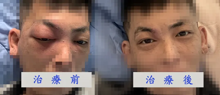 陳男眼部治療前後對照。大林慈濟醫院提供