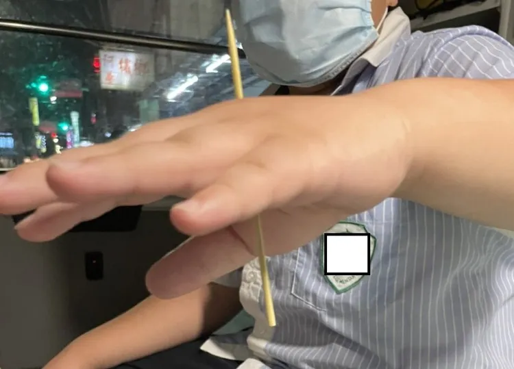 男童左手掌遭竹籤插入貫穿。民眾提供