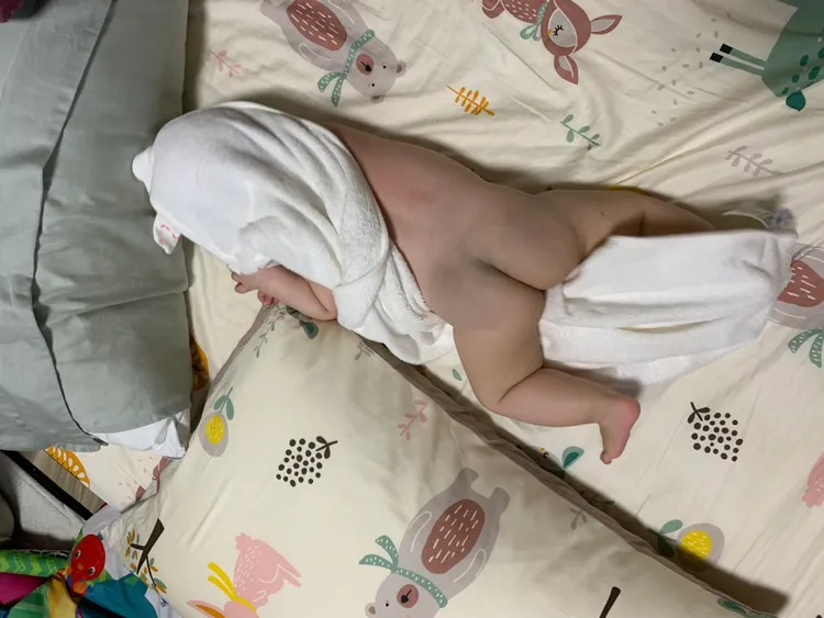 一歲多幼兒臀部有大片蒙古斑。林芳如攝