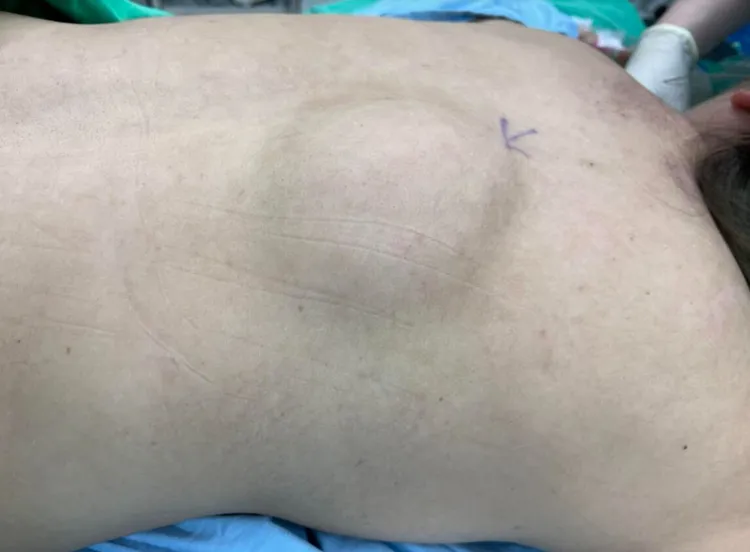 婦人背部長了8公分大的脂肪瘤。亞大醫院提供