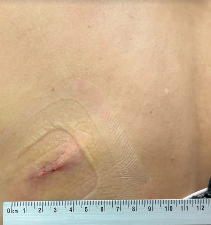 脂肪瘤透過微創手術摘除，傷口小、恢復快。亞大醫院提供