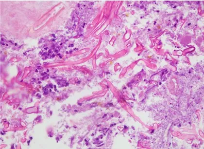 染疫、罹癌易遭黴菌侵襲 死亡率直逼5成!基因定序助醫當神探準確開藥
