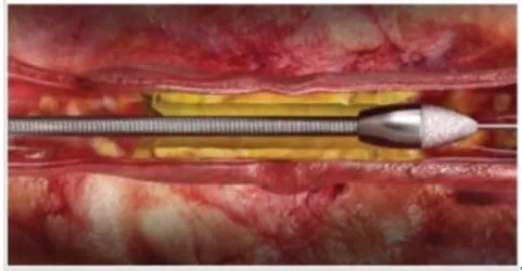 鑽石旋磨術示意圖。門諾醫院提供