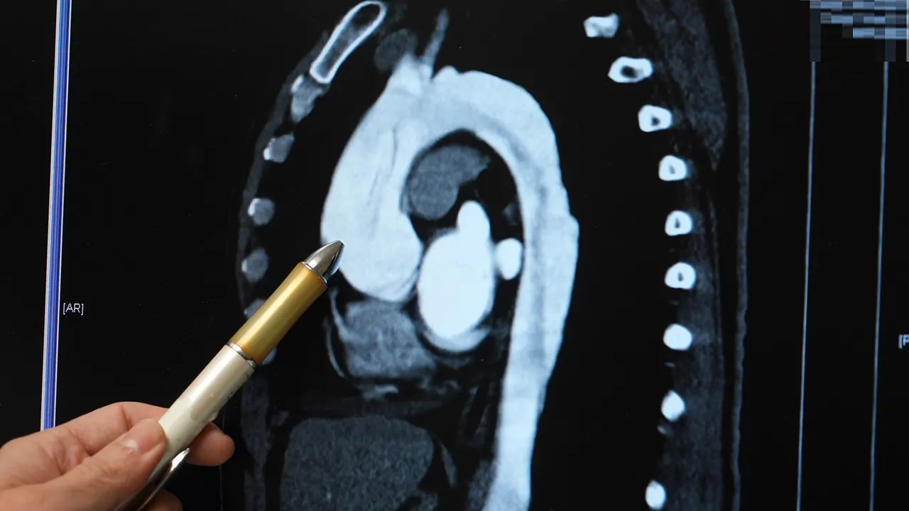 主動脈剝離的死亡率隨時間暴增,每小時至少增加1%,逾48小時則死亡率過半。彰基提供