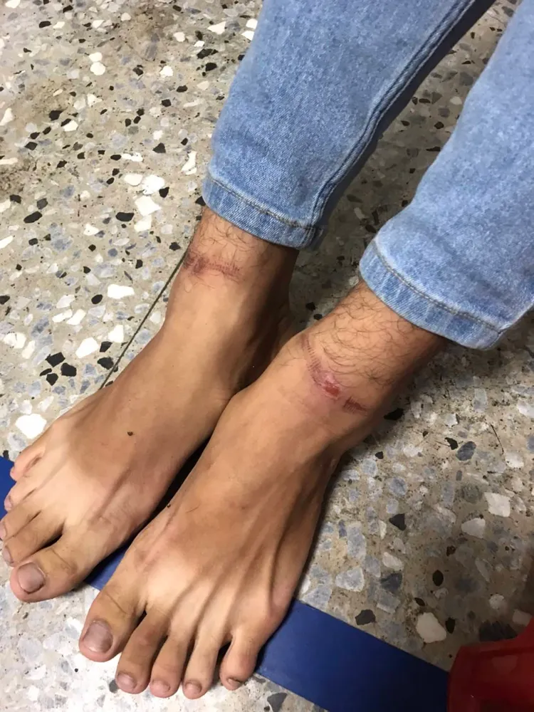 被害人雙腳被銬的傷痕。翻攝畫面