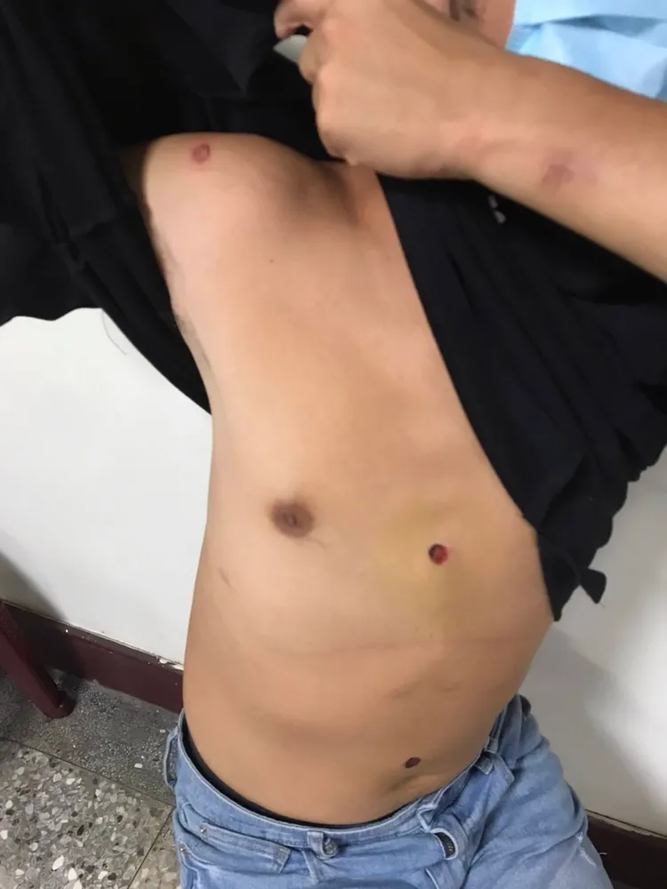 被害人身上被燙的菸疤。翻攝畫面