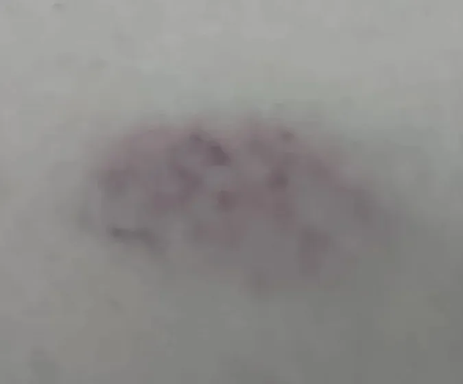 女網友大腿被咬到瘀青。翻攝自論壇Dcard