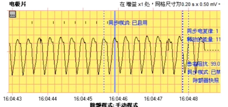 電擊前患者心律呈現不規則狀態。台中市消防局提供