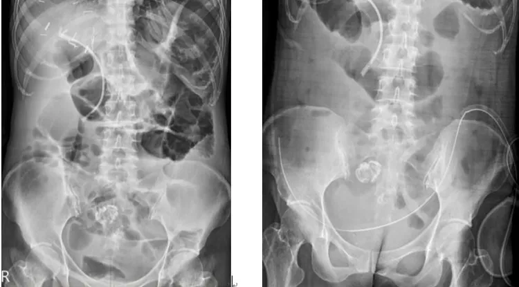 林女士接受腹腔高壓氣霧化療合併免疫細胞療法，成功將原本嚴重腸阻塞(左圖)癌細胞消失(右圖)。中國附醫提供