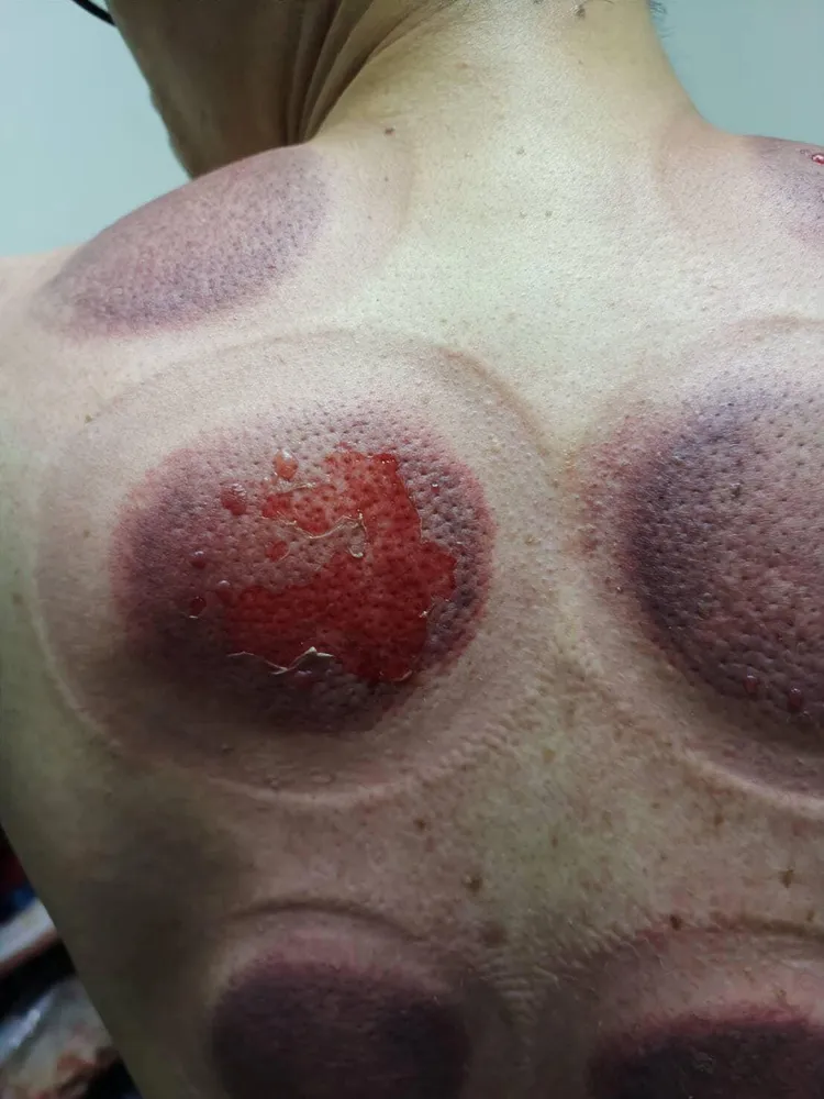 一張張拔罐後的燒燙傷照，看了怵目驚心。翻攝爆料公社