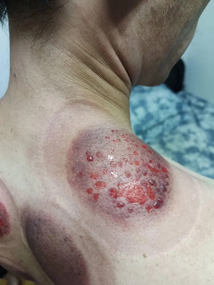 拔罐處明顯燒燙傷且起了小水泡。翻攝爆料公社