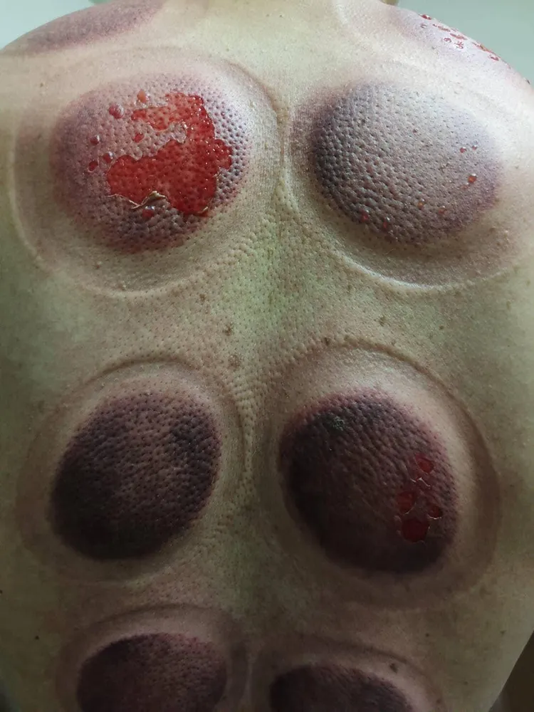 後背皮膚共1.5％體表面積二度燙傷。翻攝爆料公社