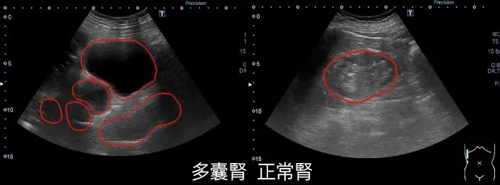 左圖為患者腎臟經超音波檢查，發現長出多個水泡囊腫導致腎臟腫大數倍，右圖為正常腎。亞大醫院提供V