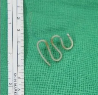 林恩楷醫師從老婦體內取出刺破子宮的避孕器。林恩楷醫師提供