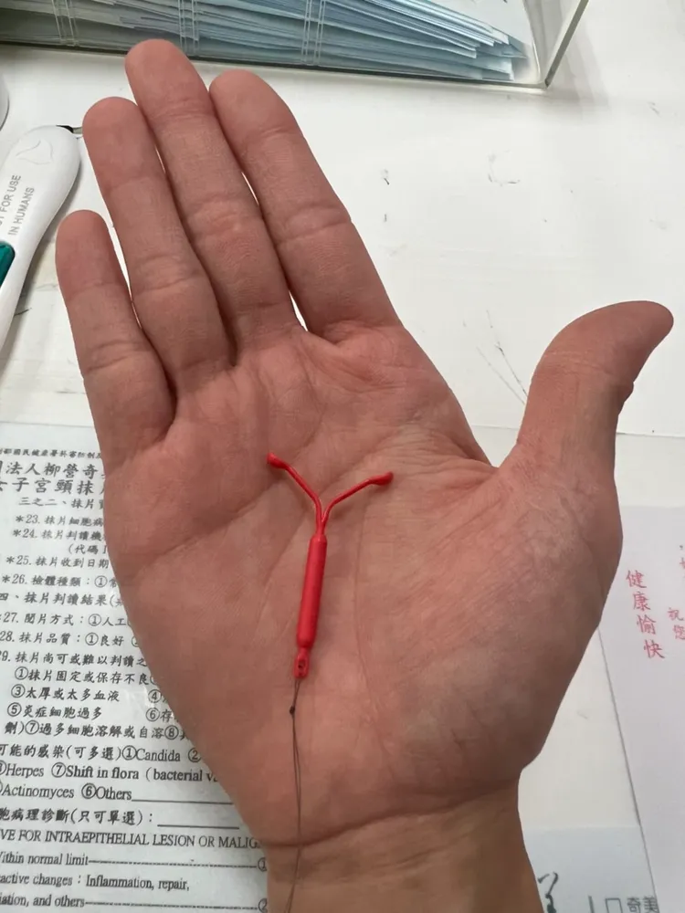 在子宮內置放避孕器（掌心內物品），可干擾胚胎形成與著床，達到避孕的效果。葛菁如醫師提供
