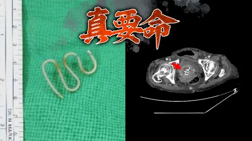 獨家|她腹痛送醫驚見「子宮破洞」已救不了 奪命元兇竟是避孕器
