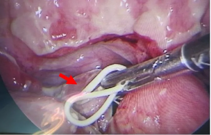 林恩楷醫師以器械取出老婦體內的避孕器（箭頭處）。林恩楷醫師提供