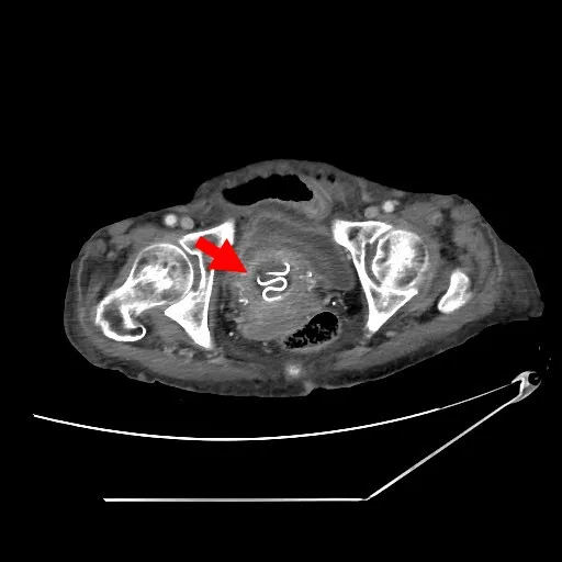電腦斷層影像中，可看到婦人子宮內的避孕器（箭頭處）。林恩楷醫師提供