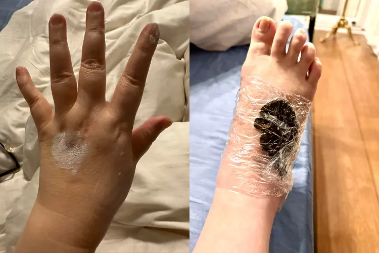 陳文茜手腳腫脹到看不到血管。翻攝陳文茜臉書