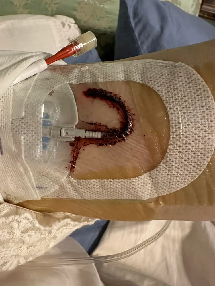 陳文茜裝上人工血管。翻攝陳文茜臉書