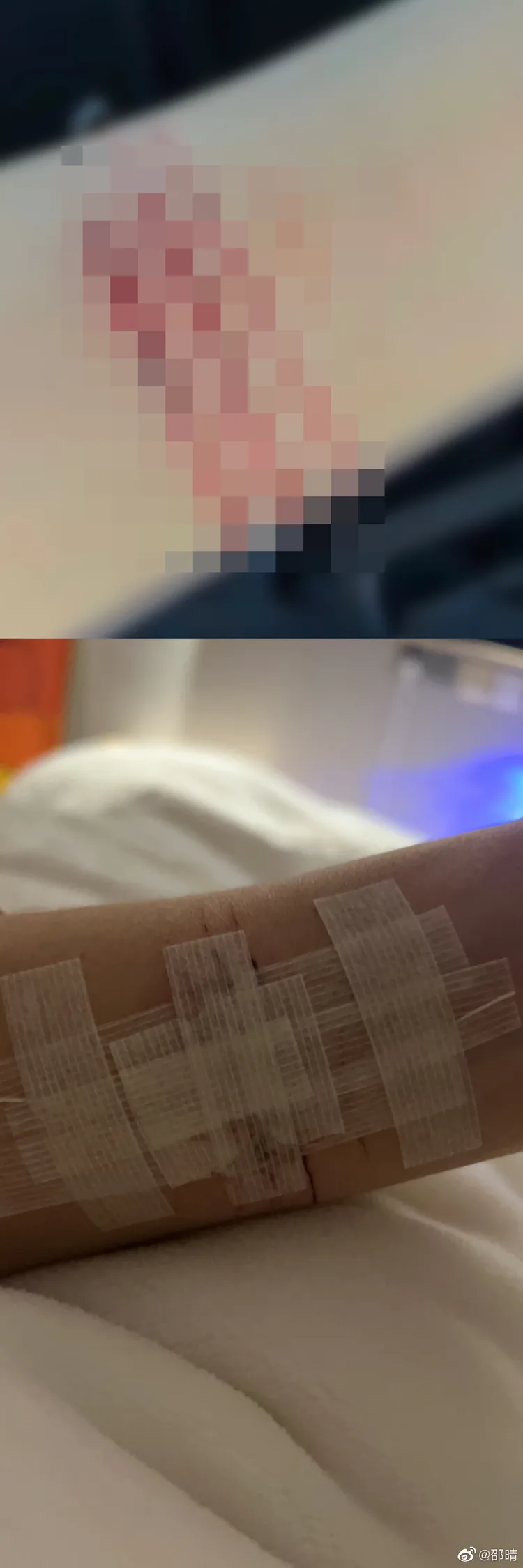 邵晴PO出手腕傷口照。翻攝邵晴微博