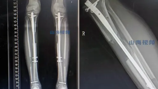 19歲小隻馬「斷骨圓夢增高6公分」　然後她就再站不起來了