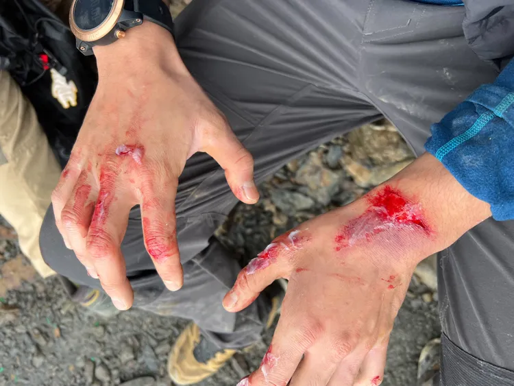 還有山友手部遭到落石擊中，造成擦挫傷流血。民眾提供