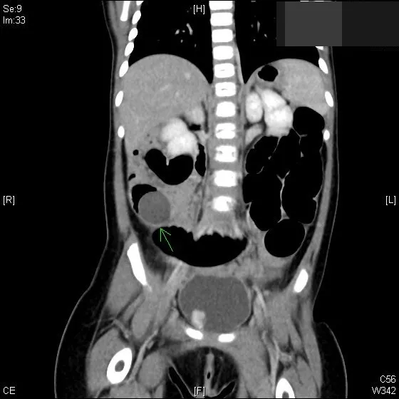 電腦斷層檢查中發現，男童小腸被圓形異物（箭頭處）塞住，事後開刀取出，發現是膨脹後的水晶寶寶。賴宛孜醫師提供