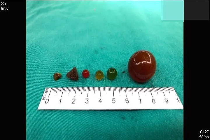 男童在第一次手術時，蔡逸文醫師在他的小腸裡，取出多顆大小不一的水晶寶寶，有些外觀完整，有些則已碎裂。賴宛孜醫師提供