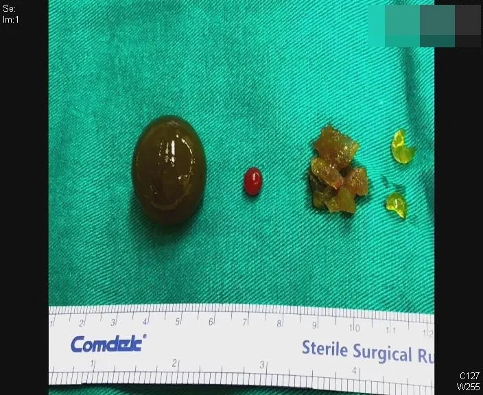 男童在第一次手術時，蔡逸文醫師在他的小腸裡，取出多顆大小不一的水晶寶寶或碎片，有的在腸液浸潤下，已膨脹到如魯蛋般大。賴宛孜醫師提供