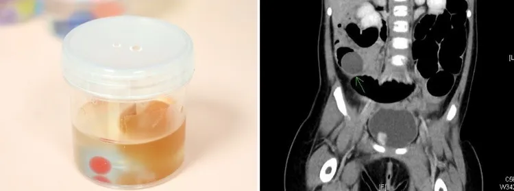 電腦斷層檢查可看到男童小腸被圓形異物（箭頭處）塞住（右）。開刀取出發現是膨脹後的水晶寶寶（左）。賴宛孜醫師提供