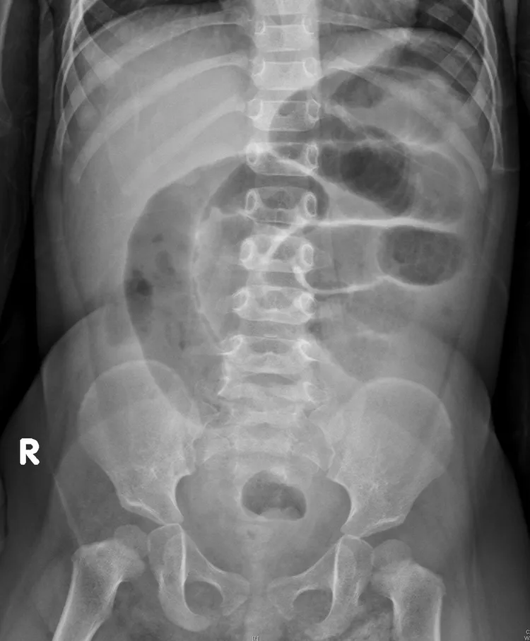 在X光片可看到男童小腸腸道脹大，大腸的腸氣減少，有腸堵塞情況。賴宛孜師提供