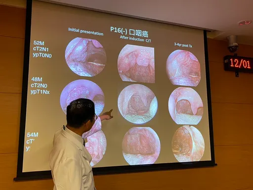 口愛釀致癌危機 高雄榮總精準治療降有口難言副作用