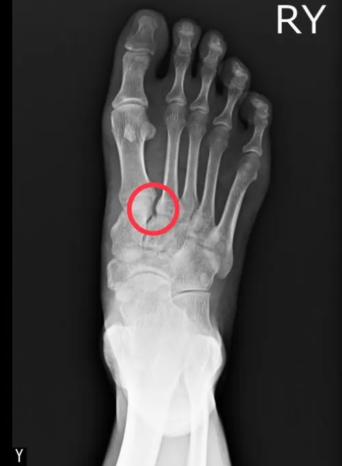 患者照X光發現，跗趾關節有開離。大里仁愛醫院提供