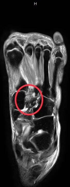 患者經MRI檢查發現蹠跗韌帶有受傷。大里仁愛醫院提供