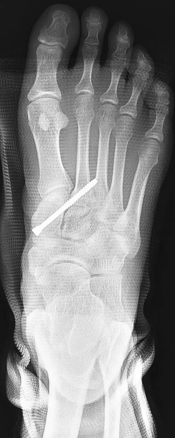 患者接受微創鋼釘固定手術治療後的ｘ光照。大里仁愛醫院提供