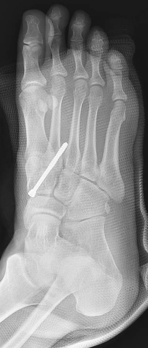 微創鋼釘固定手術治療後的Ｘ光照。大里仁愛醫院提供                                                                                                                                                         