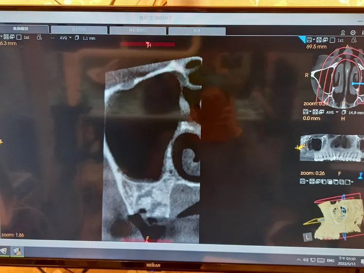 領有重大傷病卡的賴女，拍了多次X光都沒有穿鉛衣，讓他相當不安。投訴人提供，