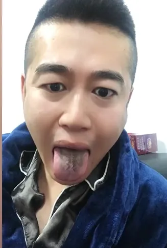 天津男子確診後舌頭變黑。翻攝微博