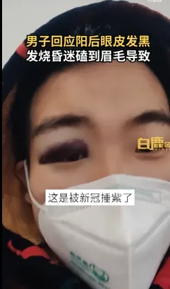 四川男子說他是發燒燒昏了，把眼睛撞青。翻攝微博
