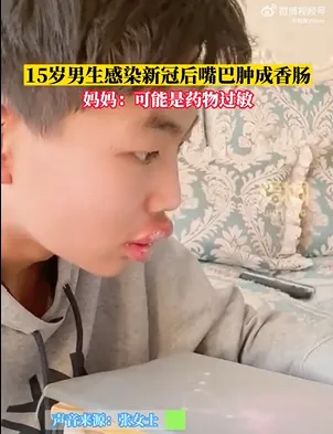 山西少年雙唇紅腫。翻攝微博