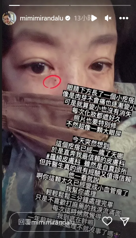 路嘉怡眼下肉芽一年後竟變血管瘤。翻攝路嘉怡IG