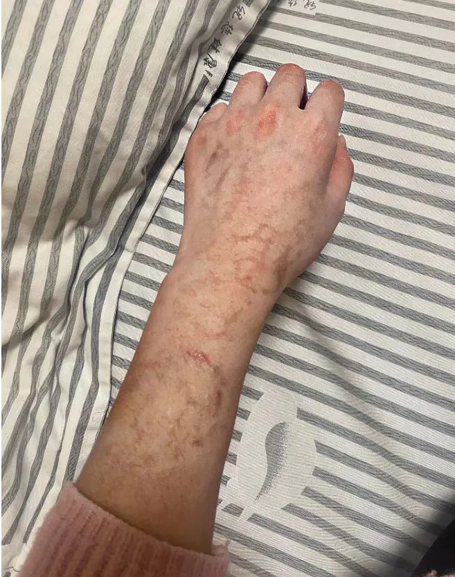 她出院時身上仍是明顯的傷痕未消。引自《瀟湘晨報》