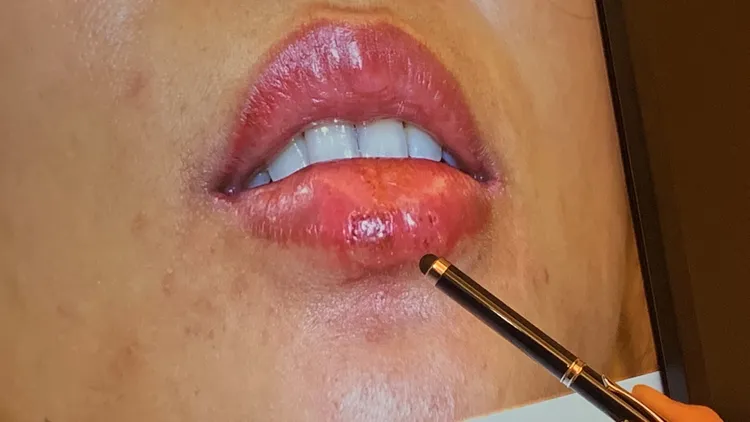 女子紋唇補色疑因病毒從傷口入侵，下唇長了兩顆皰疹。曾雪蒨攝
