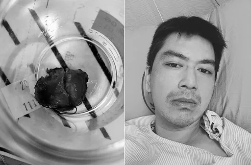 內有驚悚照！8點檔男星照胃鏡驚見十二指腸腫瘤　緊急動刀切除