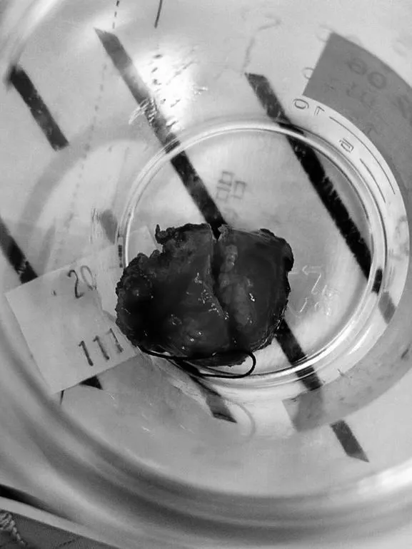 腫瘤的驚悚照。翻攝潘逸安臉書