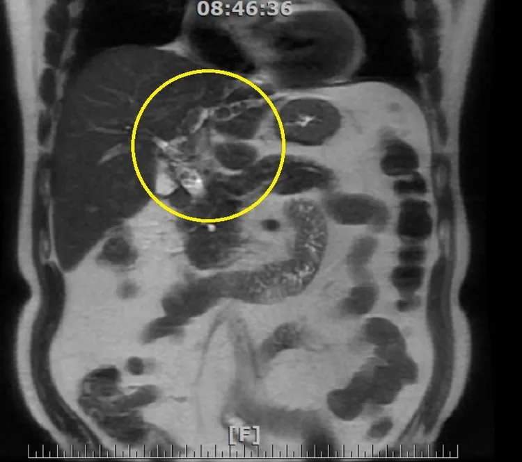 經核磁共振檢查影像，黃圈處可看出左肝、膽管及膽囊有結石。南投醫院提供