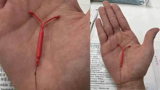 避孕器藏2致死危機 異位好發這時間點